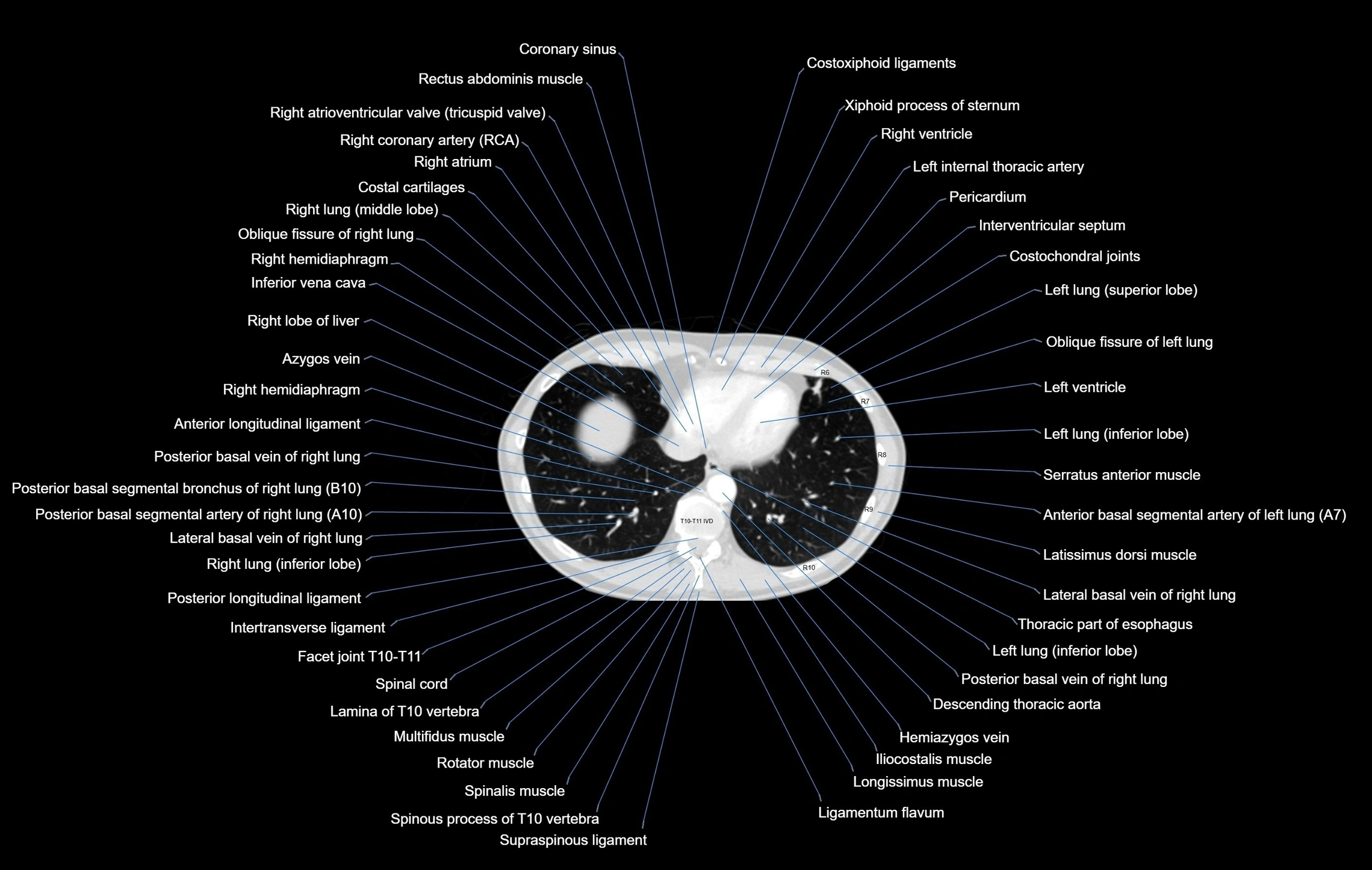 CT chest (thorax) lung window window labelled axial cross sectional anatomy radiology image-00093.webp